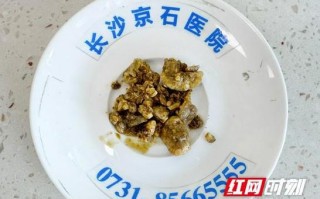 尿结石吃核桃